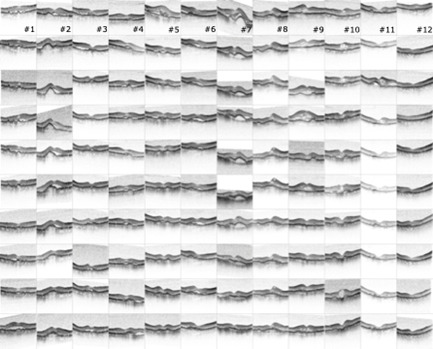 Baseline characteristics and progression of neovascular age-related macular degeneration in patients receiving over 60 intravitreal injections of anti-vascular endothelial growth factor.