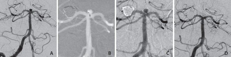 Woven EndoBridge Device Migration and Microsnare Retrieval Strategy: Single Institutional Case Reports with Technical Video Demonstration.