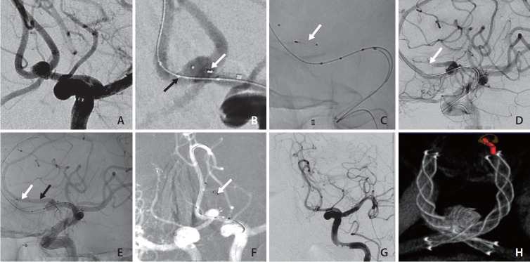 Woven EndoBridge Device Migration and Microsnare Retrieval Strategy: Single Institutional Case Reports with Technical Video Demonstration.