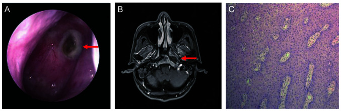 Treating radiation‑related nasopharyngeal necrosis with endostar in patient with nasopharyngeal carcinoma: A report of two cases and a literature review.