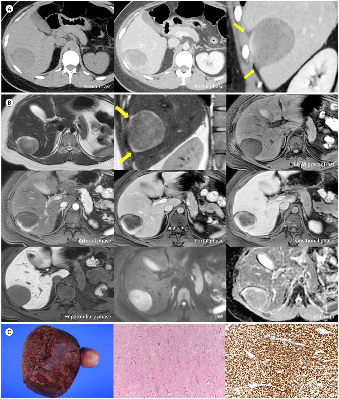 Extremely Rare CT and MRI Findings of Peritoneal Leiomyoma Mimicking Hepatic Mass: A Case Report.