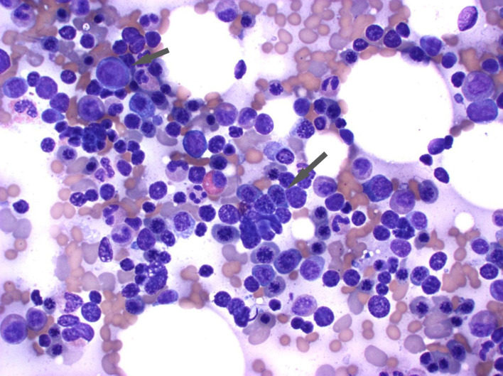 Intravenous Immunoglobulin-Associated Severe Hemolytic Anemia.