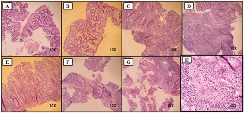 A Masking Effect: A Case of Initial Presentation of Ulcerative Colitis After Discontinuing Growth Hormone Therapy.