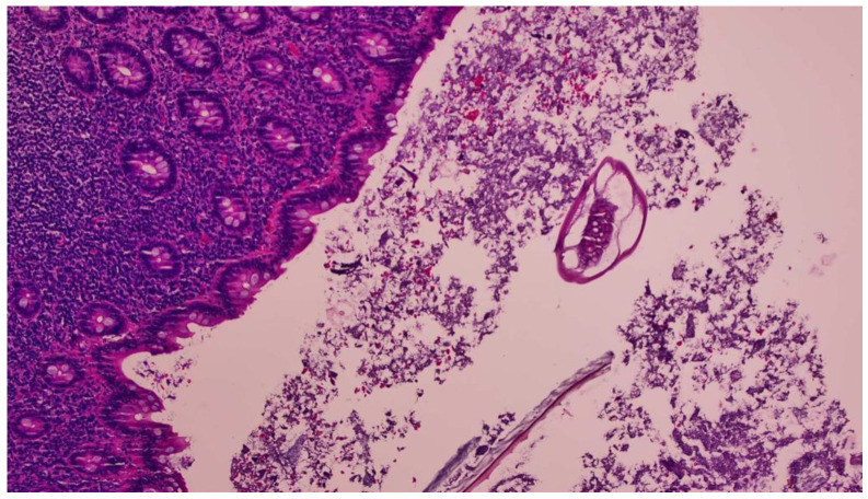 <i>Enterobius vermicularis</i> Related Acute Appendicitis: A Case Report and Review of the Literature.