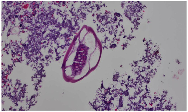 <i>Enterobius vermicularis</i> Related Acute Appendicitis: A Case Report and Review of the Literature.