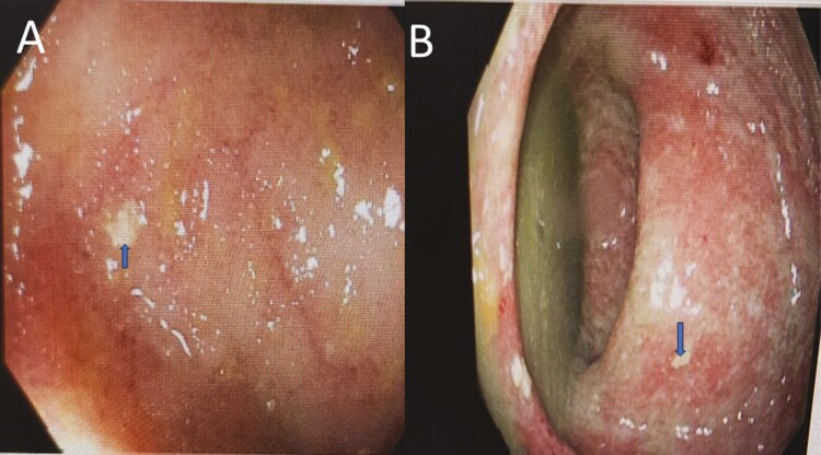 A Masking Effect: A Case of Initial Presentation of Ulcerative Colitis After Discontinuing Growth Hormone Therapy.