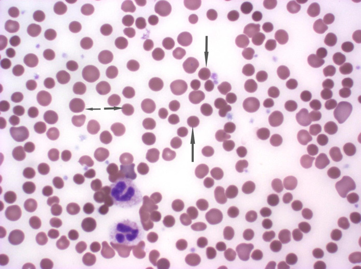 Intravenous Immunoglobulin-Associated Severe Hemolytic Anemia.