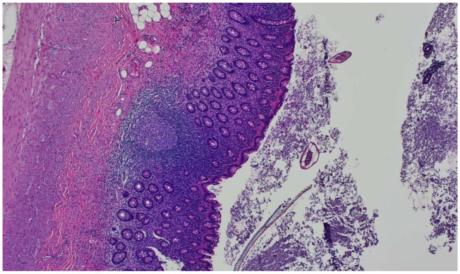 <i>Enterobius vermicularis</i> Related Acute Appendicitis: A Case Report and Review of the Literature.