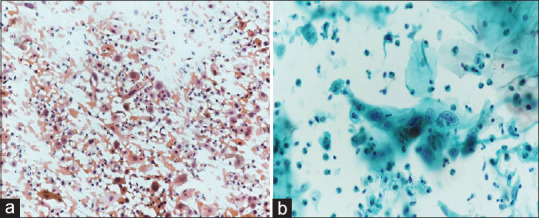Comparative Analysis of Conventional Cytology and Liquid-Based Cytology in the Detection of Carcinoma Cervix and its Precursor Lesions.