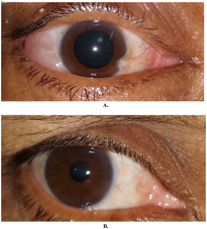 Observing the factors affecting fibrovascular regrowth after pterygium excision and comparing the efficacy and complications of conjunctival autograft with sutures versus fibrin glue.