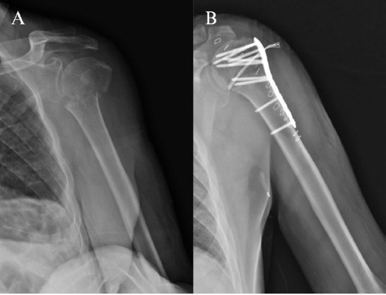 Comparison of intramedullary nail and plate osteosynthesis in humerus surgical neck fracture.