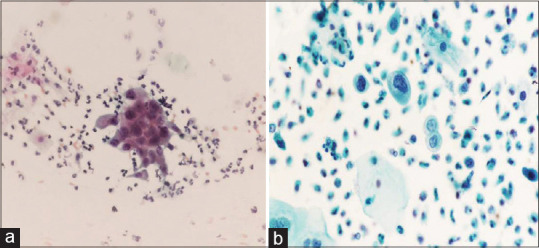 Comparative Analysis of Conventional Cytology and Liquid-Based Cytology in the Detection of Carcinoma Cervix and its Precursor Lesions.