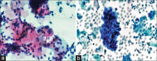 Comparative Analysis of Conventional Cytology and Liquid-Based Cytology in the Detection of Carcinoma Cervix and its Precursor Lesions.