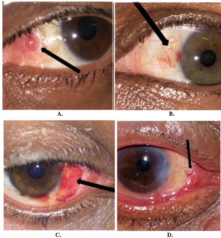 Observing the factors affecting fibrovascular regrowth after pterygium excision and comparing the efficacy and complications of conjunctival autograft with sutures versus fibrin glue.