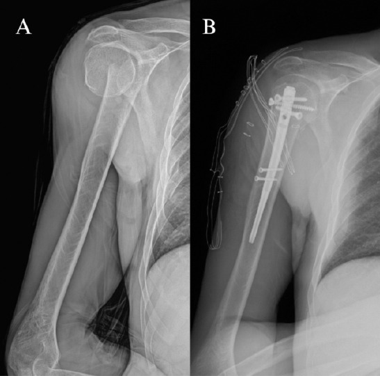 Comparison of intramedullary nail and plate osteosynthesis in humerus surgical neck fracture.