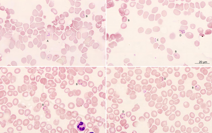 Successful treatment with doxycycline monotherapy for human infection with Babesia venatorum (Babesiidae, Sporozoa) in China: a case report and proposal for a clinical regimen.