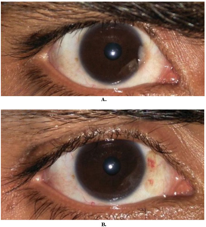 Observing the factors affecting fibrovascular regrowth after pterygium excision and comparing the efficacy and complications of conjunctival autograft with sutures versus fibrin glue.