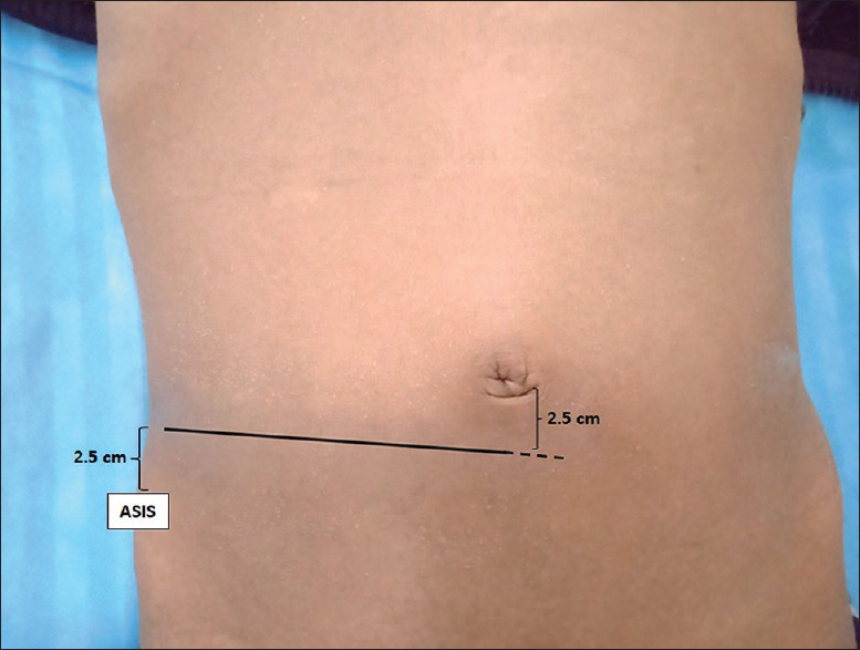 Evaluation of the outcome of right subumbilical transverse incision approach for the management of complicated appendicitis in paediatric age group - A multi-institutional retrospective study.