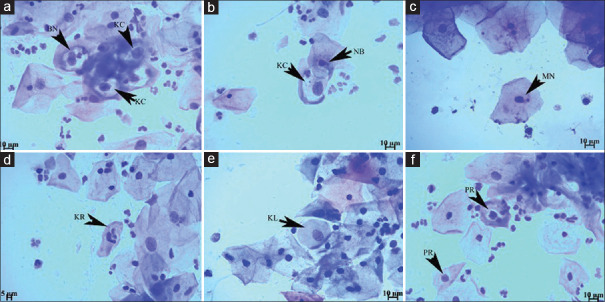 The Structural Profile of HPV 18 in Terms of Chromosomal and Nuclear Degenerative Changes and the Ratio of Nucleus/Cytoplasm on Liquid based Cervical Cells.