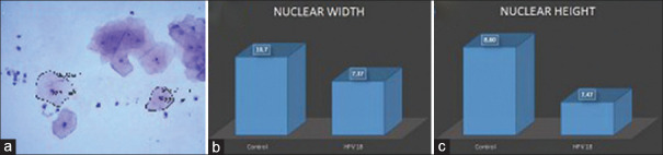 The Structural Profile of HPV 18 in Terms of Chromosomal and Nuclear Degenerative Changes and the Ratio of Nucleus/Cytoplasm on Liquid based Cervical Cells.
