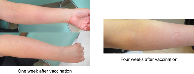 COVID arm that appeared in the contralateral upper extremity after mRNA-1273 booster inoculation.