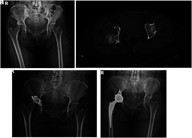 Analysis of predictive factors for post-traumatic osteoarthritis and poor outcomes in acetabular fractures treated surgically.