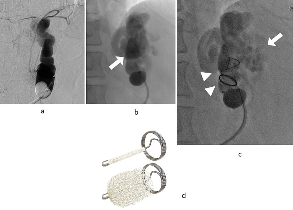 Plug-assisted Retrograde Transvenous Obliteration-II for Gastric Varices: A Case Report.