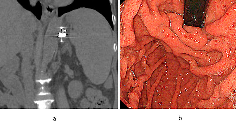 Plug-assisted Retrograde Transvenous Obliteration-II for Gastric Varices: A Case Report.