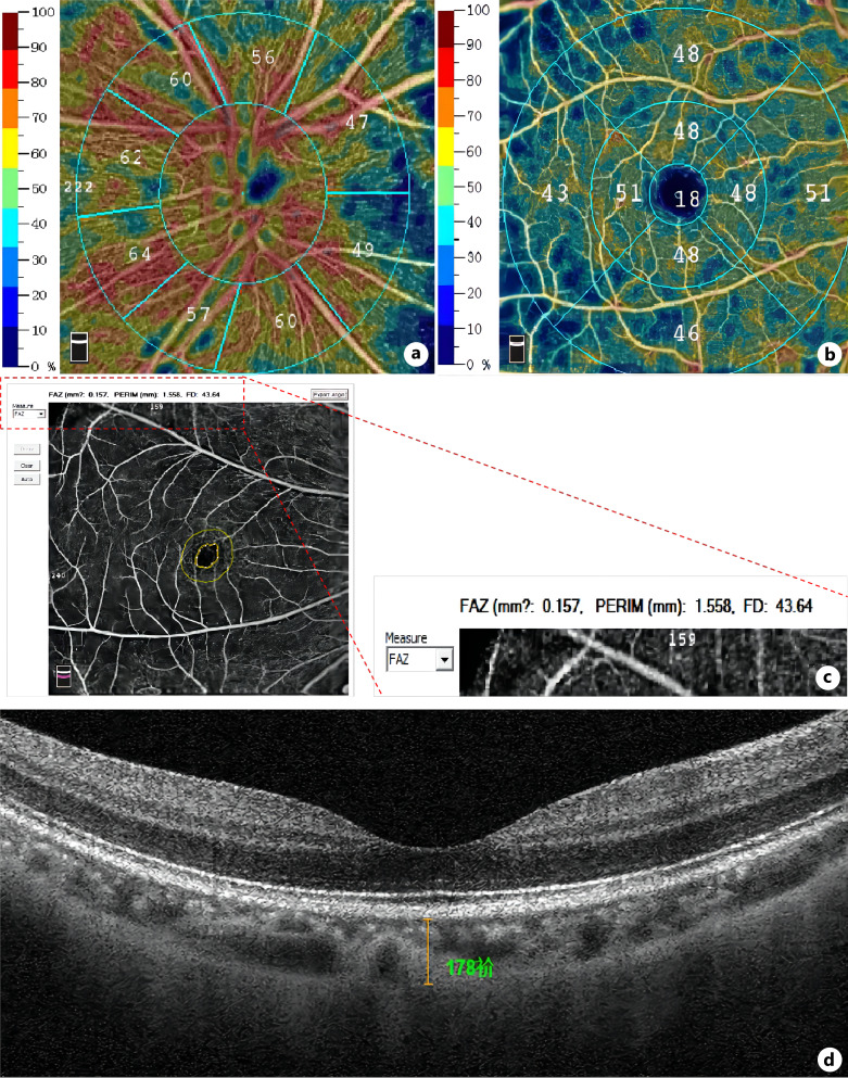 Distribution of the Retinal Microcirculation Based on the Morphology of Peripapillary Atrophy in High Myopia.