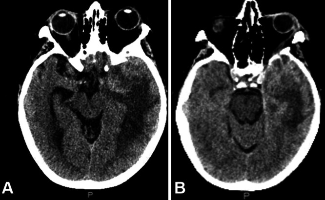 Intratumoral abscess complicating a postradiation-induced World Health Organization grade II meningioma: illustrative case.