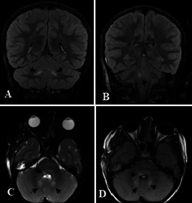 Langerhans cell histiocytosis located in the spheno-orbital bone and the pons: illustrative case.
