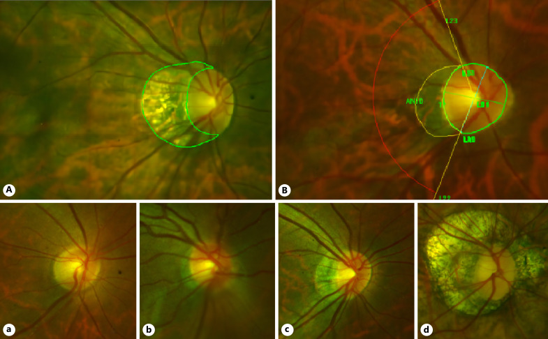 Distribution of the Retinal Microcirculation Based on the Morphology of Peripapillary Atrophy in High Myopia.