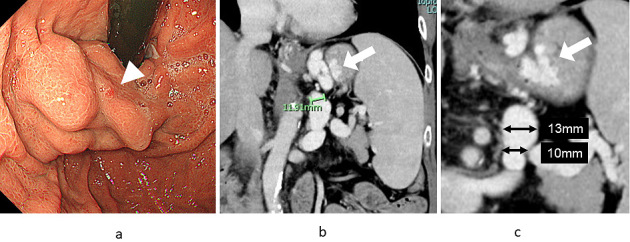 Plug-assisted Retrograde Transvenous Obliteration-II for Gastric Varices: A Case Report.