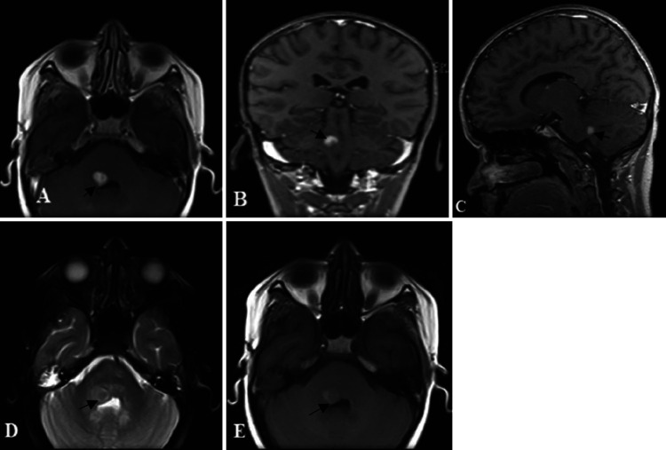 Langerhans cell histiocytosis located in the spheno-orbital bone and the pons: illustrative case.