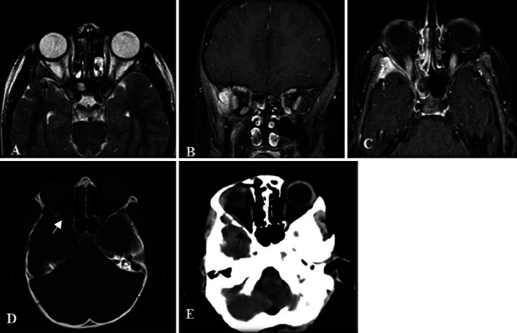 Langerhans cell histiocytosis located in the spheno-orbital bone and the pons: illustrative case.