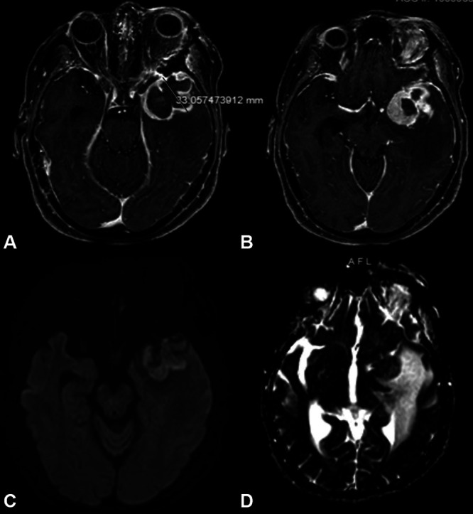 Intratumoral abscess complicating a postradiation-induced World Health Organization grade II meningioma: illustrative case.