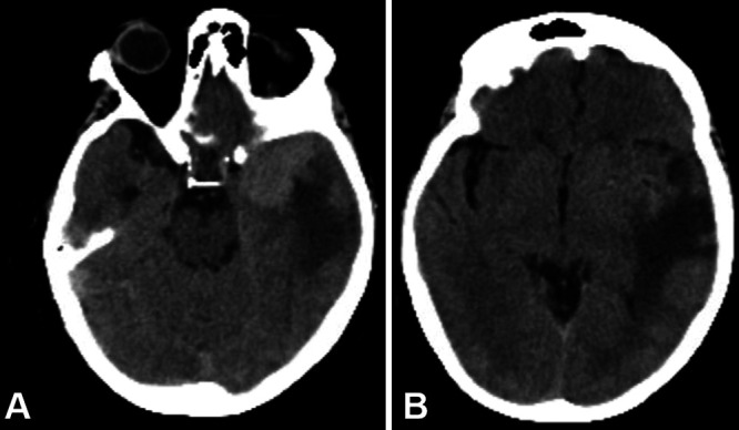 Intratumoral abscess complicating a postradiation-induced World Health Organization grade II meningioma: illustrative case.
