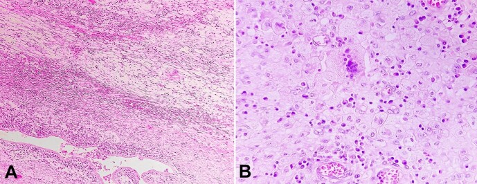 Xanthogranulomatous Endometritis with calculus formation in setting of prolapsed uterus.