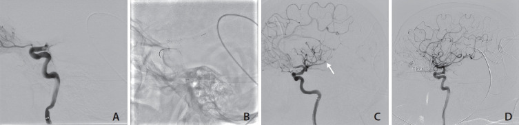 Intra-Arterial Thrombolysis to Improve Final Thrombolysis in Cerebral Infarction Score after Thrombectomy: A Case-Series Analysis.