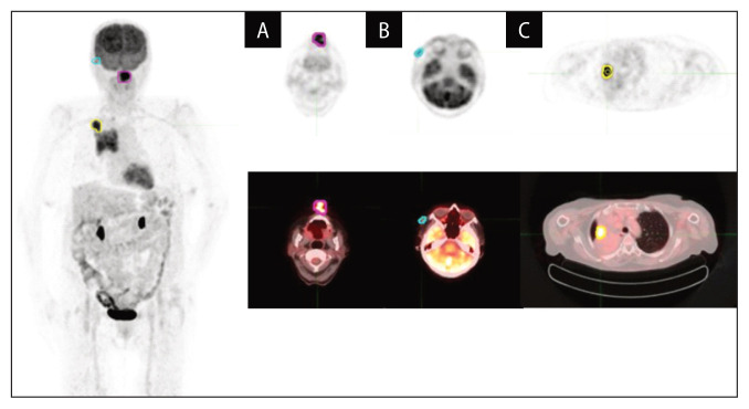 Potential use of [<sup>18</sup>F]FDG heterogeneity in discrimination of two different synchronous primary tumors.