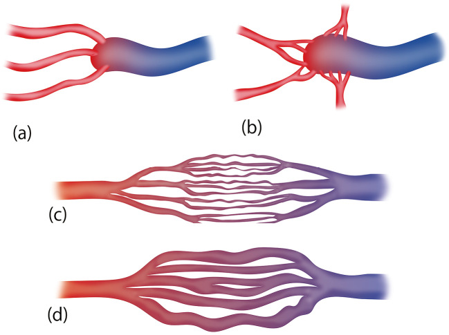 Head and Neck Arteriovenous Malformations: Clinical Manifestations and Endovascular Treatments.