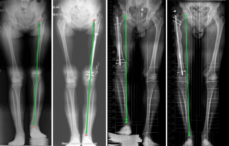 Deformity correction and limb lengthening with externally controlled motorized extendable intramedullary nails: Comparison of 2 different nails.