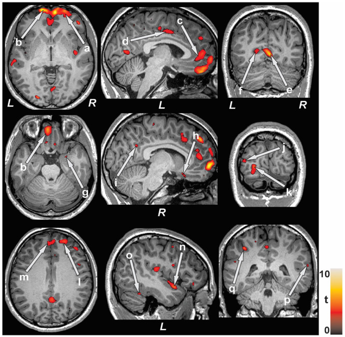 Brain Changes Linked to Cognitive Symptomatology in Homeless Youth.