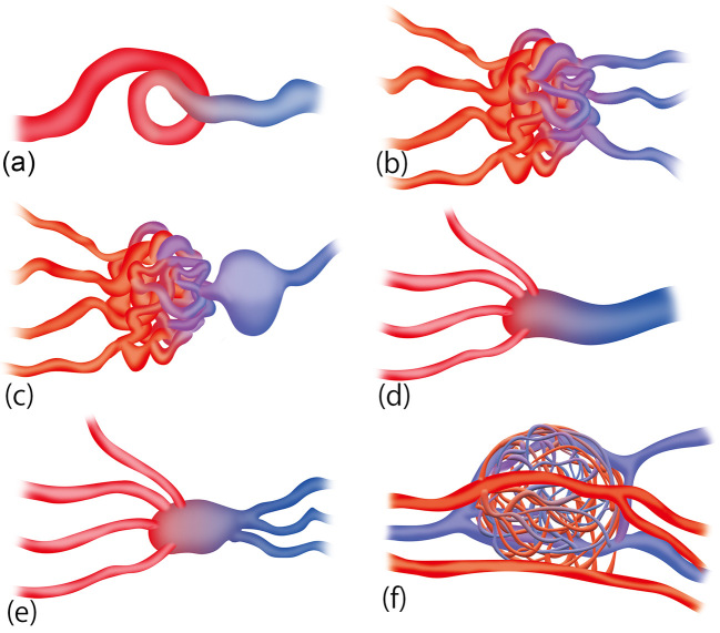 Head and Neck Arteriovenous Malformations: Clinical Manifestations and Endovascular Treatments.