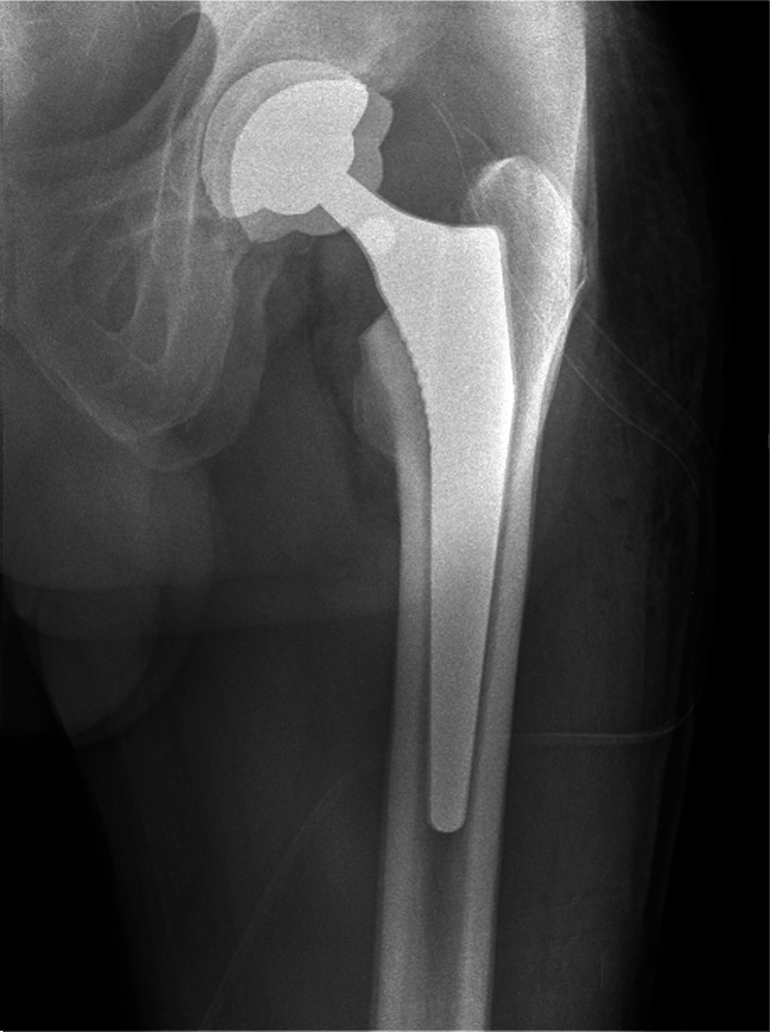 Managing early complications in total hip arthroplasty: the safety of immediate revision.