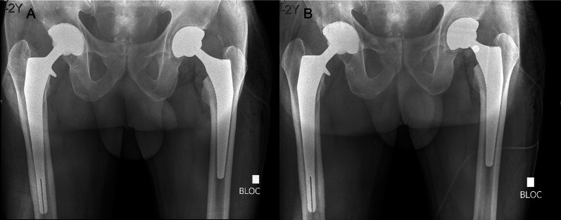 Managing early complications in total hip arthroplasty: the safety of immediate revision.