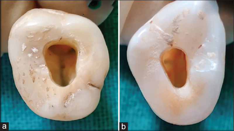 Assessment of minimally invasive file systems on resistance to fracture using traditional and contracted access cavity designs in the maxillary first and second molars.