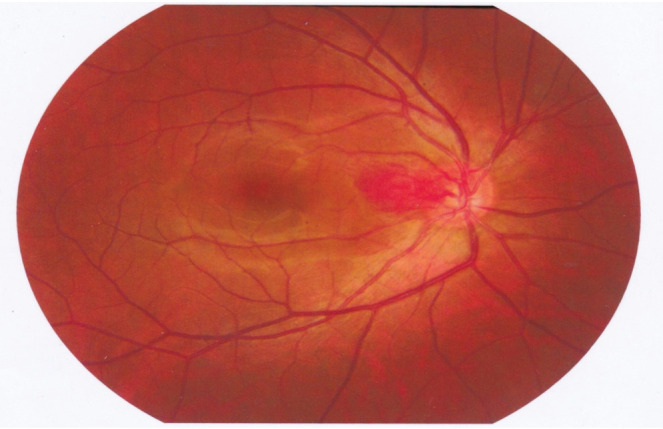 Outcome of Multiple Retinal Capillary Hemangioma Following Focal Laser and Intravitreal Bevacizumab Injection: A Case Report.