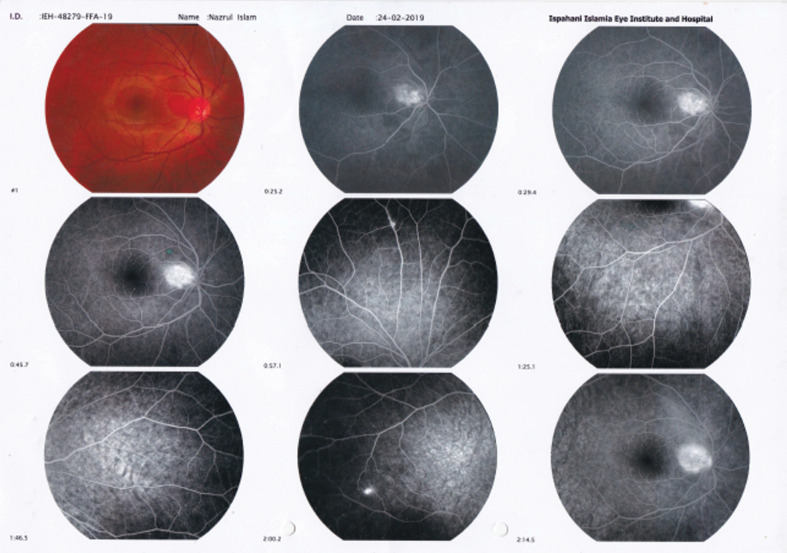 Outcome of Multiple Retinal Capillary Hemangioma Following Focal Laser and Intravitreal Bevacizumab Injection: A Case Report.