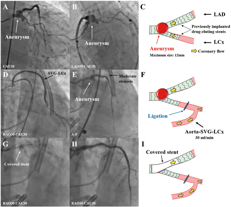 Hybrid Treatment for a Distal Left Main Coronary Artery Aneurysm　- Coronary Artery Bypass Grafting and Surgical Ligation Followed by Intraoperative Covered Stent Implantation.